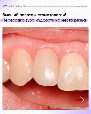 Зуб мудрости вместо имплантата: метод Алексея Гудкова.